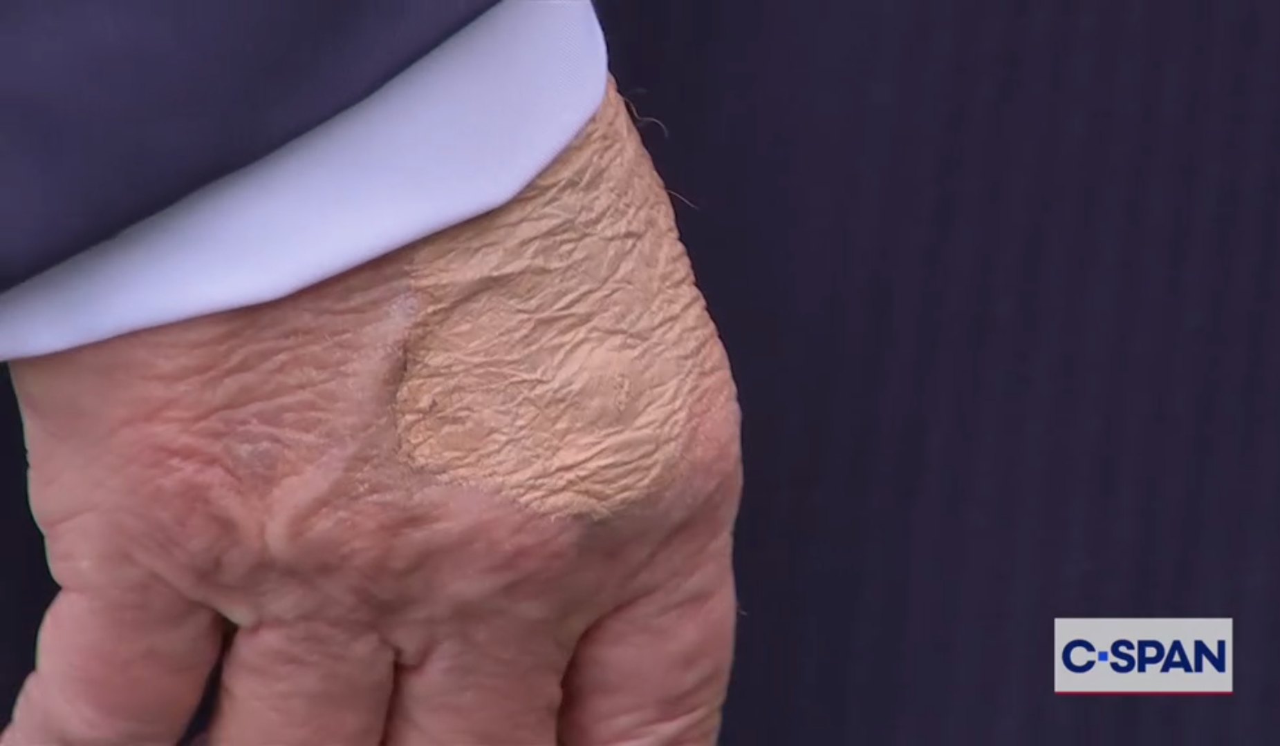 &lsquo;Cameras capture a bruise marking on President Trump&rsquo;s right hand.&rsquo;